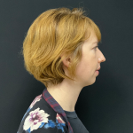 Chin Augmentation Before & After Patient #12233