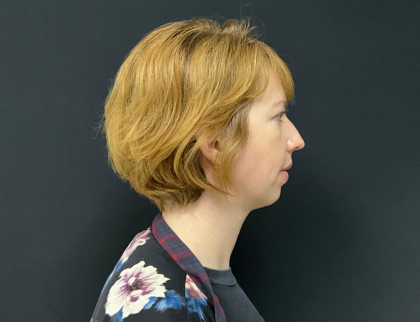 Chin Augmentation Before & After Patient #12233