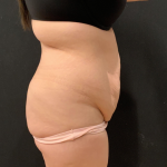 Miami Makeover Before & After Patient #12241