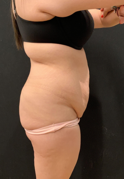 Miami Makeover Before & After Patient #12241