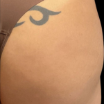 Alloclae Before & After Patient #12058