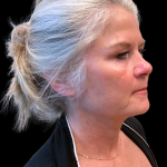Brow Lift Before & After Patient #12050