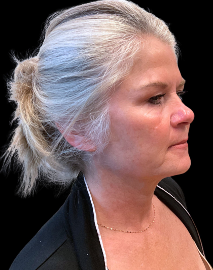 Brow Lift Before & After Patient #12050
