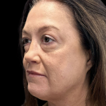 AVAVA Laser Before & After Patient #12237