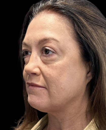 AVAVA Laser Before & After Patient #12237