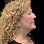 AVAVA Laser Before & After Patient #12238