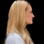 Chin Augmentation Before & After Patient #12231