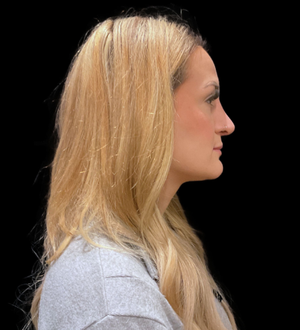Chin Augmentation Before & After Patient #12231