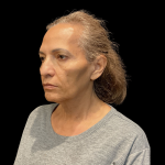 Blepharoplasty Before & After Patient #12227