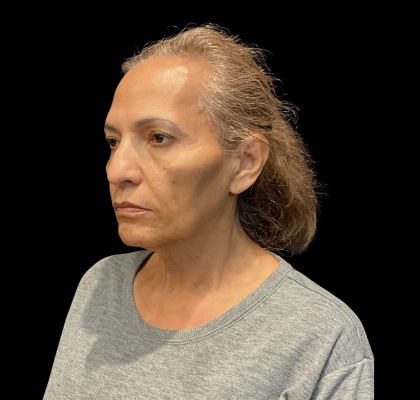 Blepharoplasty Before & After Patient #12227