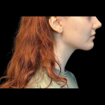 Chin Augmentation Before & After Patient #12230