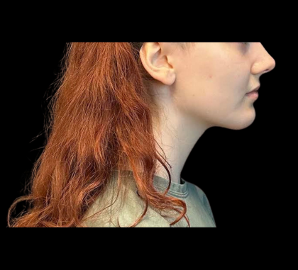 Chin Augmentation Before & After Patient #12230