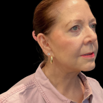 Facelift Before & After Patient #12052