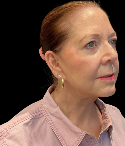 Facelift Before & After Patient #12052