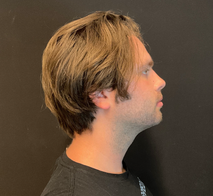 Chin Augmentation Before & After Patient #12232