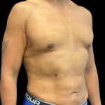 High Definition Liposuction Before & After Patient #12037