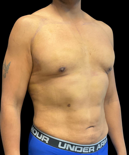 High Definition Liposuction Before & After Patient #12037