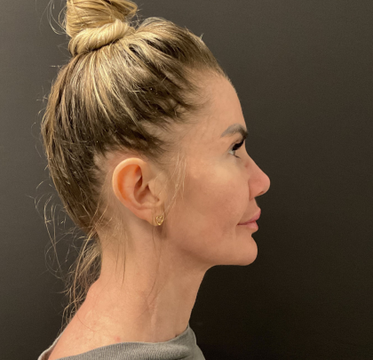 Instalift Before & After Patient #12234