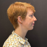 Chin Augmentation Before & After Patient #12233