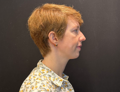 Chin Augmentation Before & After Patient #12233