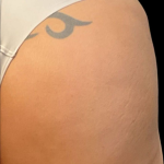 Alloclae Before & After Patient #12058