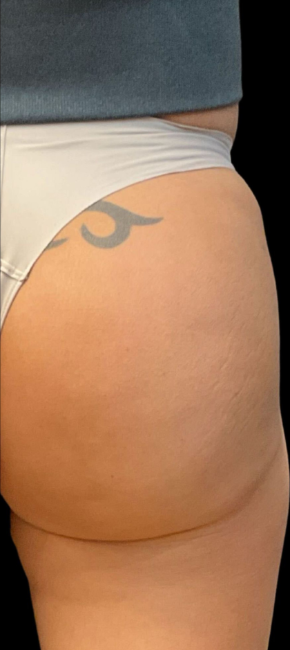 Alloclae Before & After Patient #12058