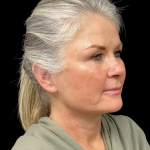 Brow Lift Before & After Patient #12050