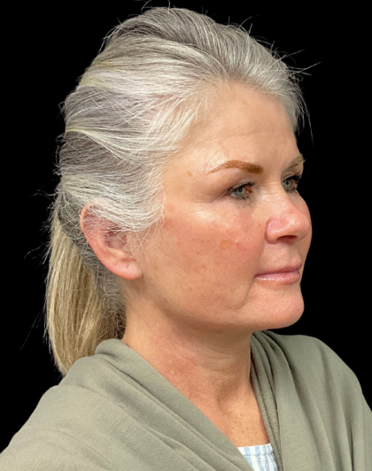 Brow Lift Before & After Patient #12050