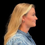 Blepharoplasty Before & After Patient #12229