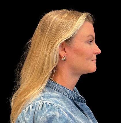 Blepharoplasty Before & After Patient #12229