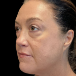 AVAVA Laser Before & After Patient #12237