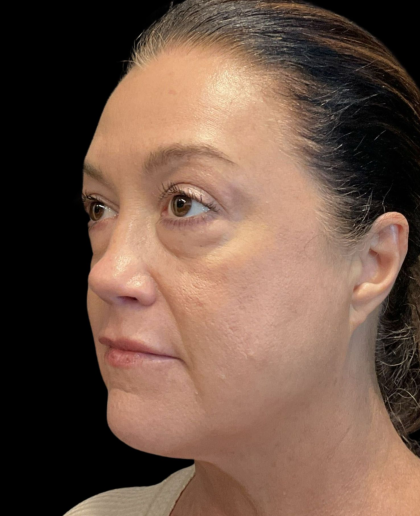 AVAVA Laser Before & After Patient #12237