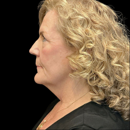AVAVA Laser Before & After Patient #12238