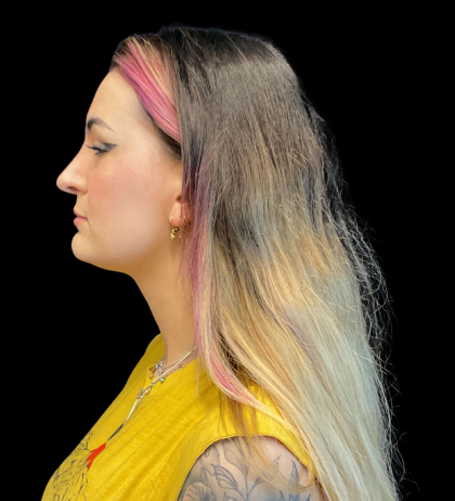 Chin Augmentation Before & After Patient #12231