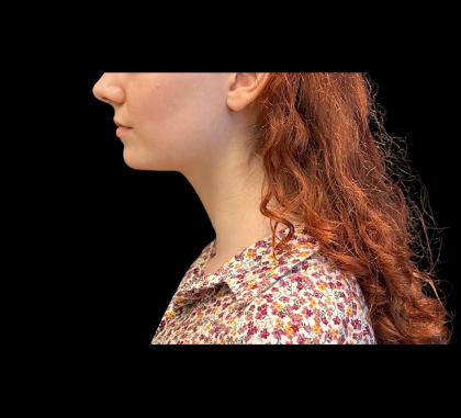 Chin Augmentation Before & After Patient #12230