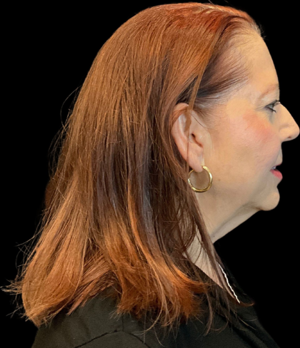 Facelift Before & After Patient #12052