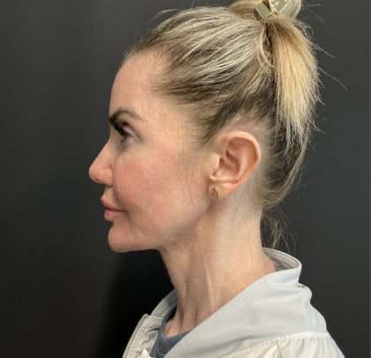 Instalift Before & After Patient #12234