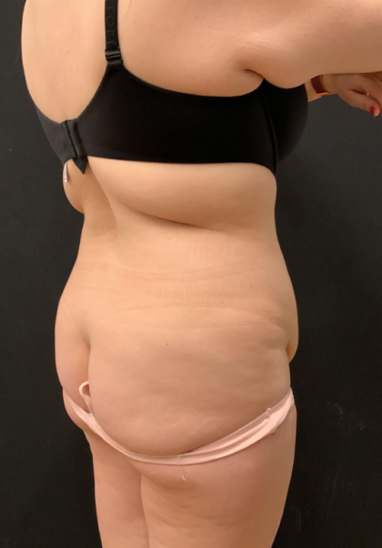 Miami Makeover Before & After Patient #12241