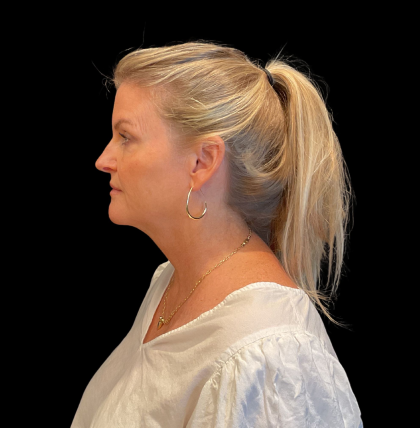 Blepharoplasty Before & After Patient #12229