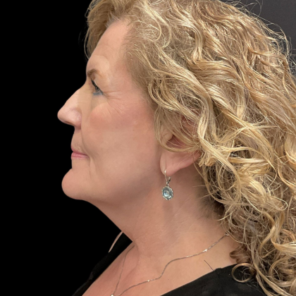 AVAVA Laser Before & After Patient #12238