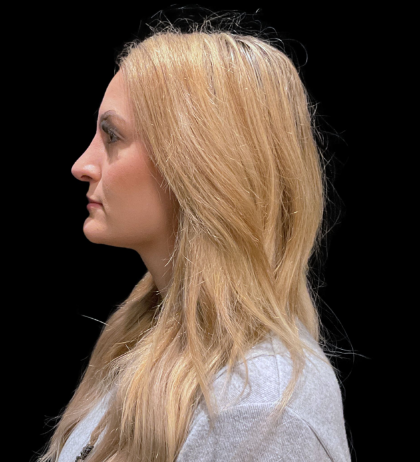Chin Augmentation Before & After Patient #12231