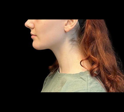 Chin Augmentation Before & After Patient #12230