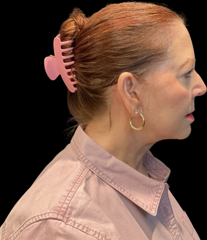Facelift Before & After Patient #12052