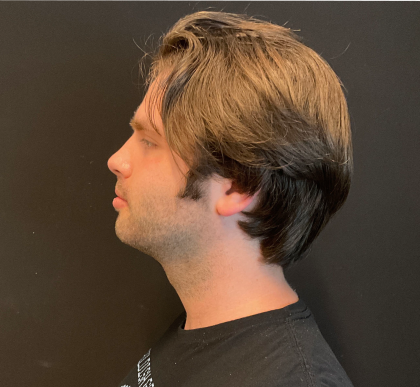 Chin Augmentation Before & After Patient #12232