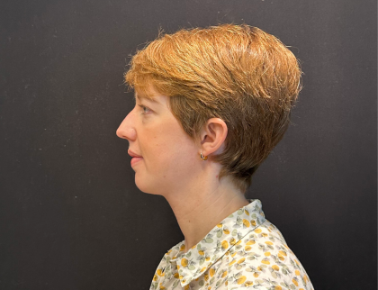 Chin Augmentation Before & After Patient #12233