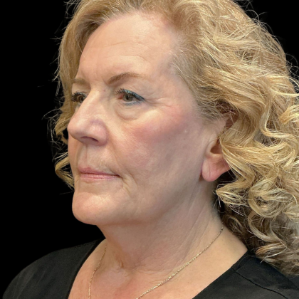 AVAVA Laser Before & After Patient #12238