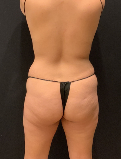 Miami Makeover Before & After Patient #12240