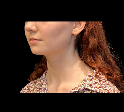 Chin Augmentation Before & After Patient #12230