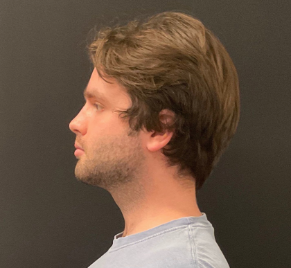 Chin Augmentation Before & After Patient #12232