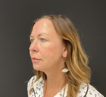 Blepharoplasty Before & After Patient #12228